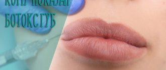 Кому показан ботокс губ – особенности процедуры и противопоказания