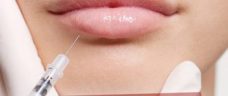 Контуринг губ гиалуроновой кислотой – какого результата можно добиться