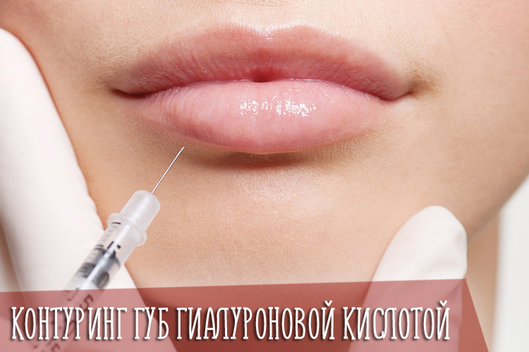 Контуринг губ гиалуроновой кислотой – какого результата можно добиться