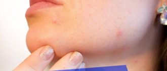 Лучшие способы избавления от прыщей на подбородке