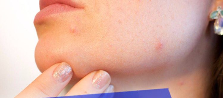 Лучшие способы избавления от прыщей на подбородке