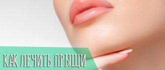 Прыщи на подбородке и шее у женщин и мужчин, причины и лечение подкожных прыщей
