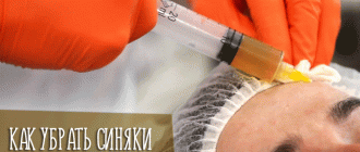 Советы косметологов, как быстро убрать синяки после мезотерапии