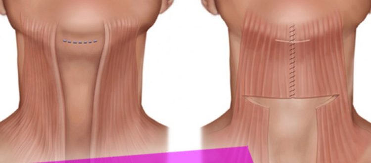 Виды подтяжки подбородка и шеи