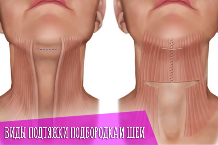 Виды подтяжки подбородка и шеи