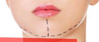 Всё, что вы должны знать перед тем, как проводить увеличение подбородка