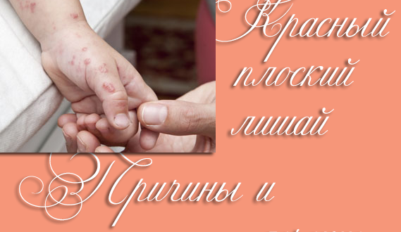 Красный плоский лишай у человека – фото, признаки и лечение