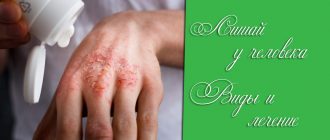 Лишай у человека – что это такое, причины и лечение