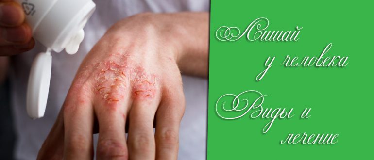 Лишай у человека – что это такое, причины и лечение