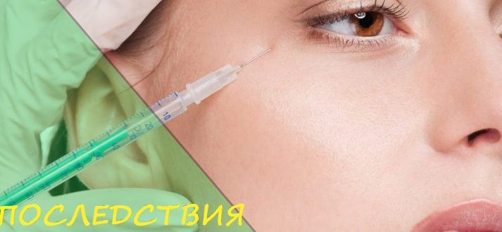 Неудачный ботокс - как минимизировать последствия