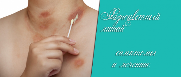 Разноцветный лишай – что это такое и как от него избавиться?