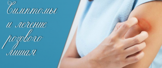 Розовый лишай у человека – симптомы и лечение