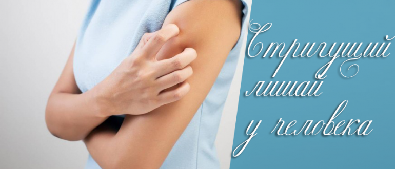 Стригущий лишай у человека – фото симптомов и лечения