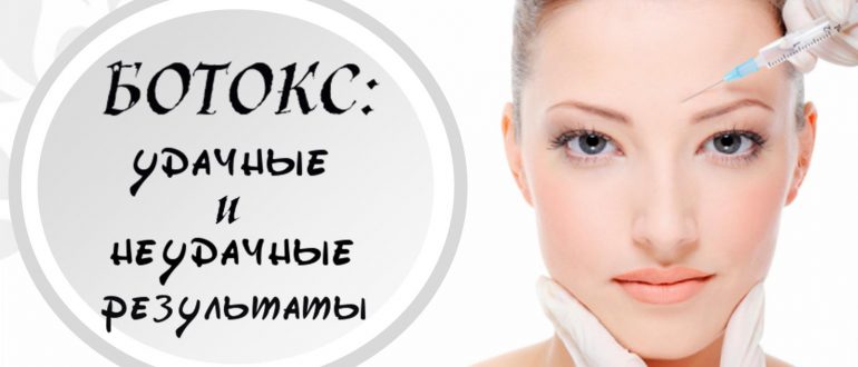 Удачные и неудачные фотографии до и после процедур ботокса