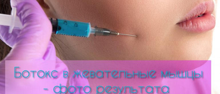 Ботокс в жевательные мышцы – фото до и после